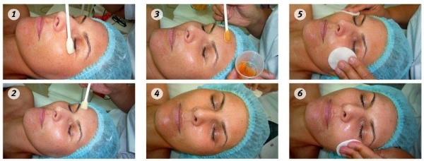 Chemical peeling of the face - what is it, how is it done at home, types and features