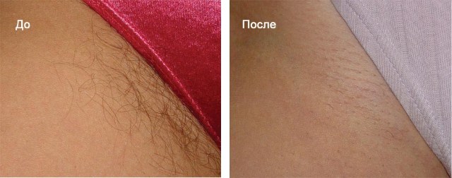 Electrolysis - what is it, how is it done, hardware hair removal. Before and after photos