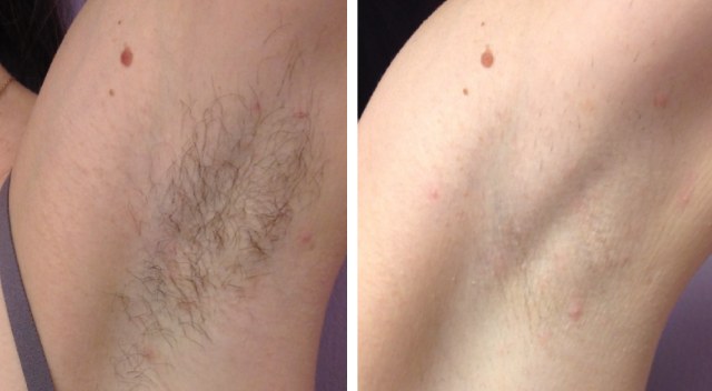 Electrolysis - what is it, how is it done, hardware hair removal. Before and after photos