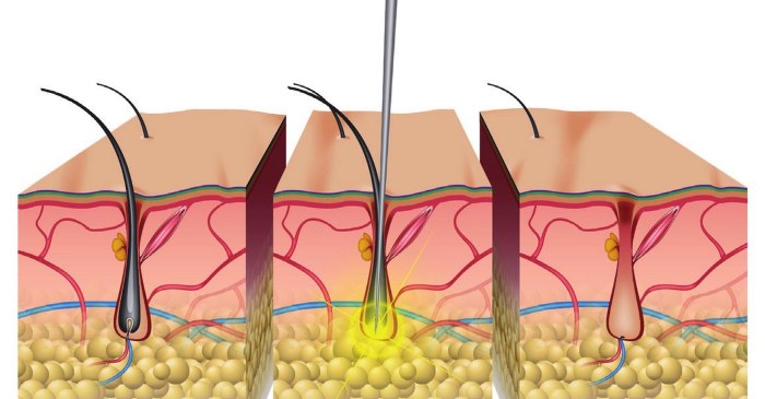 Electrolysis - what is it, how is it done, hardware hair removal. Before and after photos