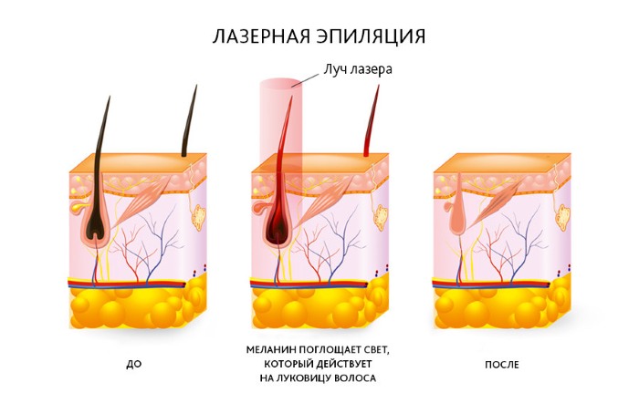 Epilazione della zona bikini a casa: shugaring, cera, laser a zona profonda