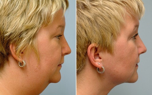 Double chin exercises are effective. How to remove cheeks and chin at home. Video