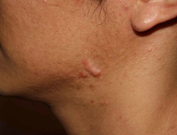 Keloid scars after surgery - what is it and why are they dangerous? What keloid scars look like. A photo