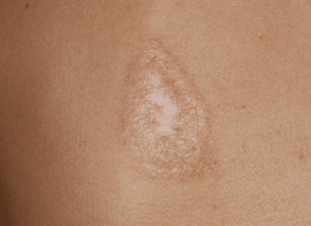 Keloid scars after surgery - what is it and why are they dangerous? What keloid scars look like. A photo