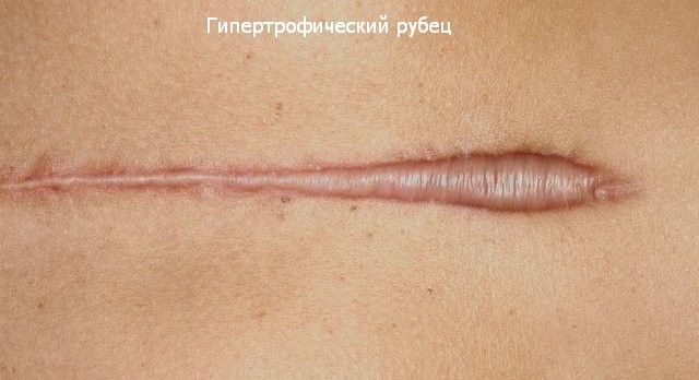 Keloid scars after surgery - what is it and why are they dangerous? What keloid scars look like. A photo