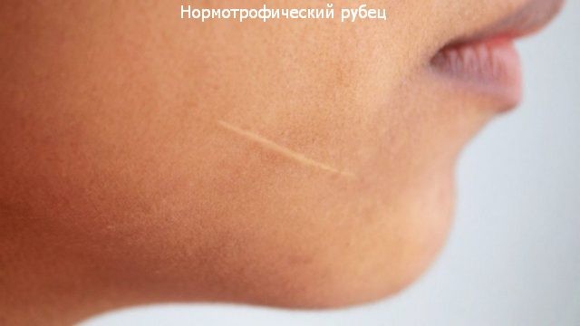 Keloid scars after surgery - what is it and why are they dangerous? What keloid scars look like. A photo