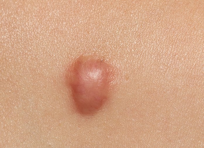 Keloid scars after surgery - what is it and why are they dangerous? What keloid scars look like. A photo