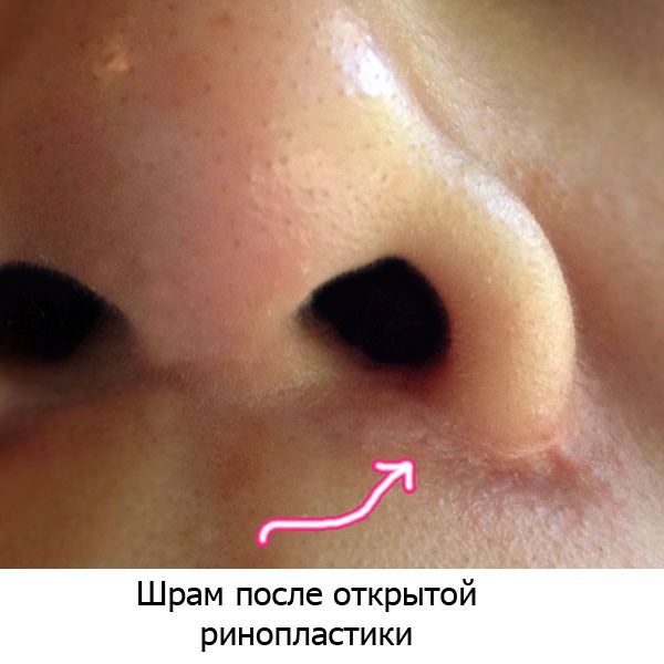 Keloid scars after surgery - what is it and why are they dangerous? What keloid scars look like. A photo