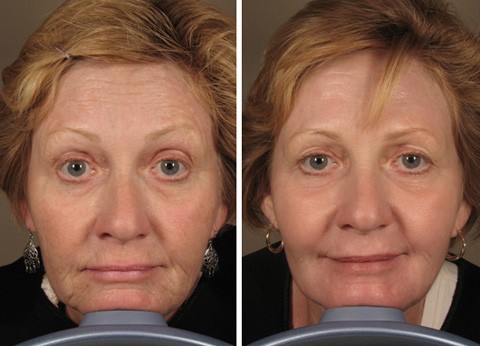 Face contour lifting - face shape correction without surgery, in the salon. Before and after photos