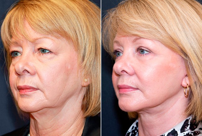 Revitonics - face building, face gymnastics. Exercise, anti-wrinkle fitness, for elasticity of the skin, muscles of the neck and face