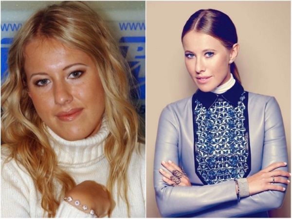 Stars before and after plastic surgery photos, rhinoplasty in celebrities