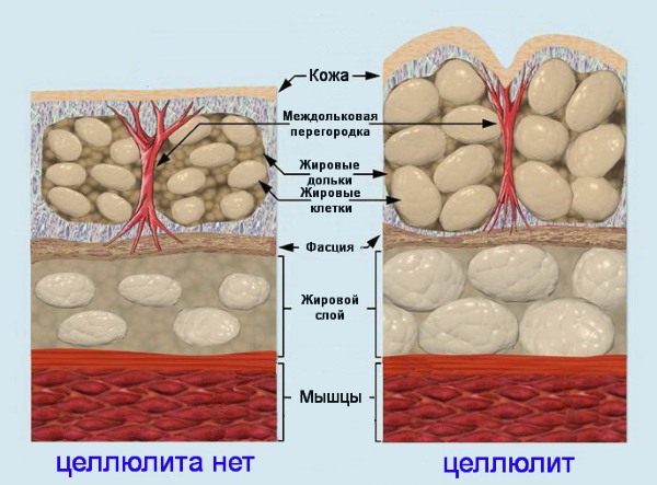 Anti-cellulite massage at home. How to do for slimming the abdomen, legs, buttocks and other parts of the body. Step by step instructions with photo