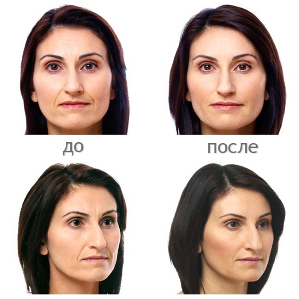 Hyaluronic acid for the face: how the injections are carried out, results, photos before and after injections, reviews