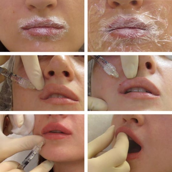 Hyaluronic acid for the face: how the injections are carried out, results, photos before and after injections, reviews