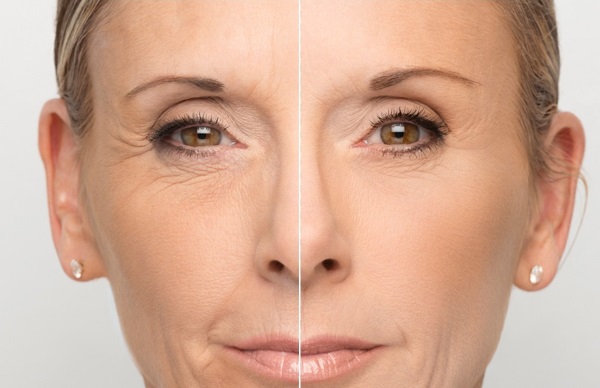 Hyaluronic acid for the face: how the injections are carried out, results, photos before and after injections, reviews