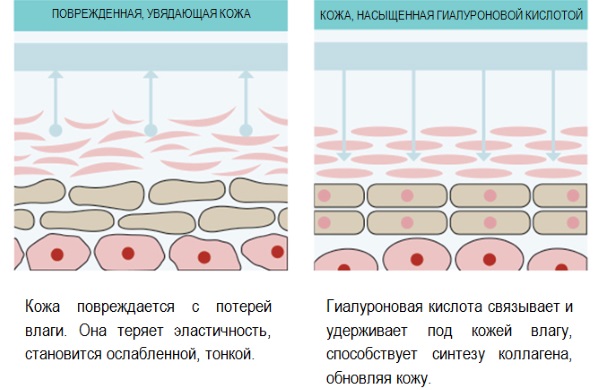 Hyaluronic acid for the face: how the injections are carried out, results, photos before and after injections, reviews