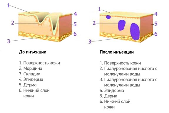 Hyaluronic acid for the face: how the injections are carried out, results, photos before and after injections, reviews