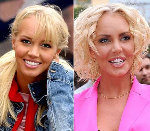 Stars before and after plastic surgery photos, rhinoplasty in celebrities