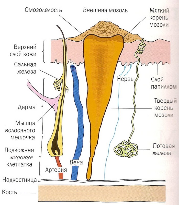 Calluses on the legs - how to treat at home with folk remedies, ointments, creams, plaster