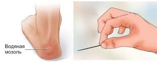 Calluses on the legs - how to treat at home with folk remedies, ointments, creams, plaster