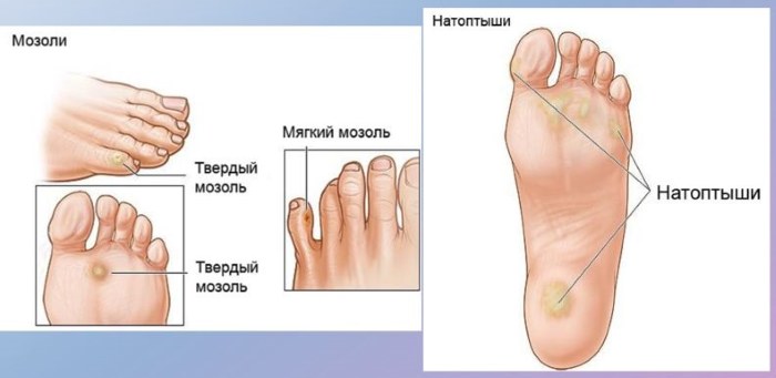 Calli sulle gambe: come trattare a casa con rimedi popolari, unguenti, creme, gesso