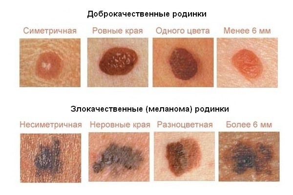 Moles on the body and face. Reasons for the appearance, types, which are dangerous and non-dangerous, photos, how to remove and whether it is possible