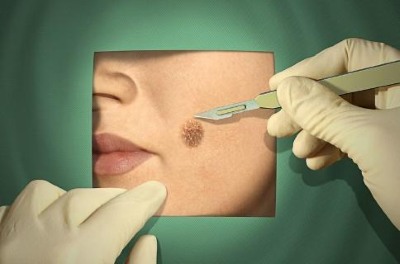 Moles on the body and face. Reasons for the appearance, types, which are dangerous and non-dangerous, photos, how to remove and whether it is possible