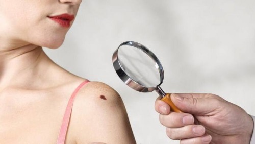 Moles on the body and face. Reasons for the appearance, types, which are dangerous and non-dangerous, photos, how to remove and whether it is possible