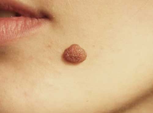 Moles on the body and face. Reasons for the appearance, types, which are dangerous and non-dangerous, photos, how to remove and whether it is possible