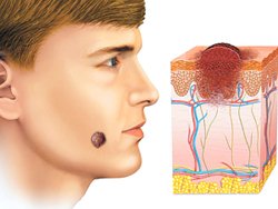 Talpe sul corpo e sul viso. Ragioni per l'aspetto, i tipi, che sono pericolosi e non pericolosi, le foto, come rimuovere e se è possibile