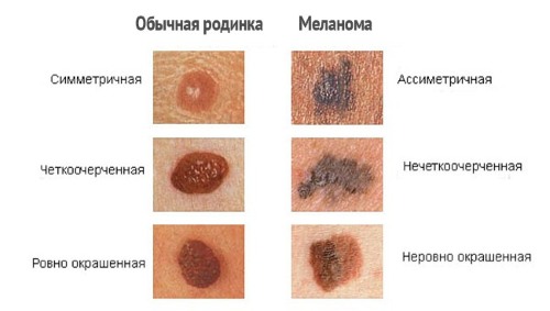 Moles on the body and face. Reasons for the appearance, types, which are dangerous and non-dangerous, photos, how to remove and whether it is possible