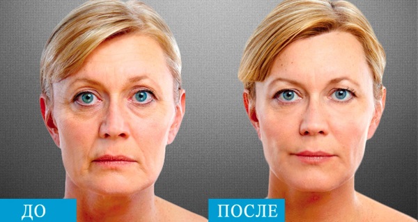 SMAS lifting - ultrasonic face cleaning. Features of the procedure, indications, contraindications, expected effect, photo