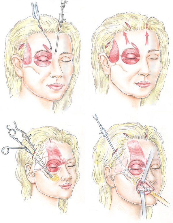 SMAS lifting - ultrasonic face cleaning. Features of the procedure, indications, contraindications, expected effect, photo