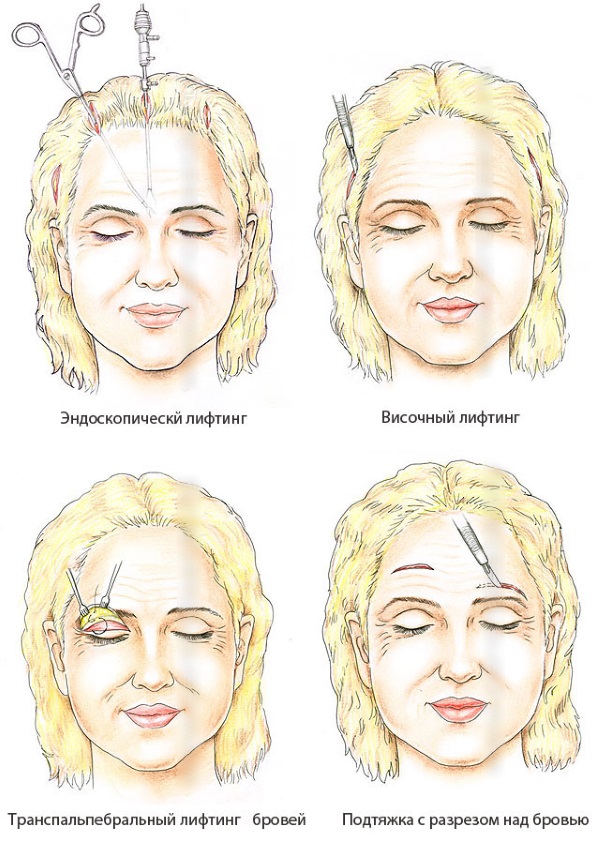 SMAS lifting - ultrasonic face cleaning. Features of the procedure, indications, contraindications, expected effect, photo