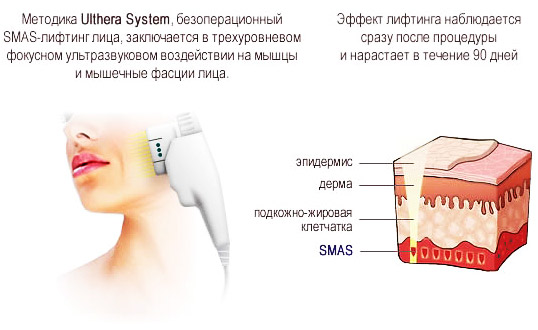 SMAS lifting - ultrasonic face cleaning. Features of the procedure, indications, contraindications, expected effect, photo