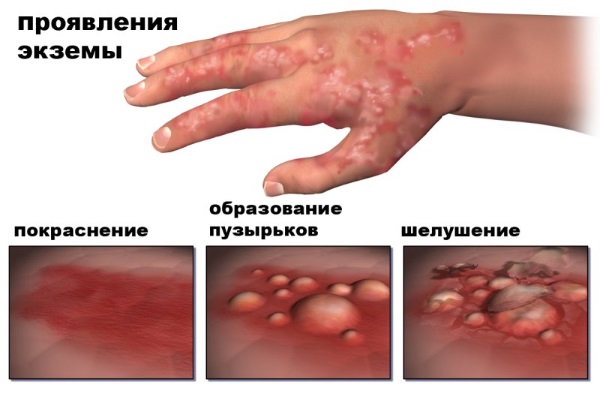 Cracks on the fingers - reasons, photo. Home treatment with folk remedies, medicinal ointments