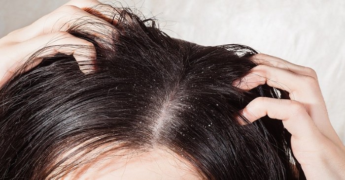 Hair loss in women - how to stop, what to do: shampoos, oils, masks, vitamin complexes