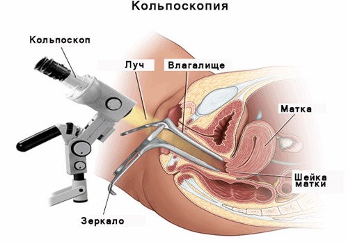 HPV in women - what is it, symptoms, types, how is it transmitted, treatment of human papillomavirus in gynecology