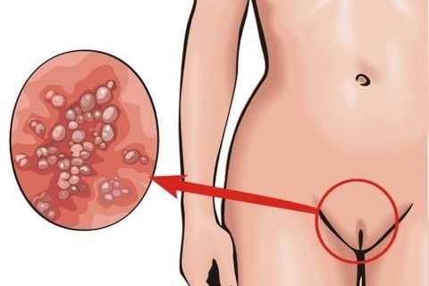 HPV nelle donne: che cos'è, sintomi, tipi, come viene trasmesso, trattamento del papillomavirus umano in ginecologia