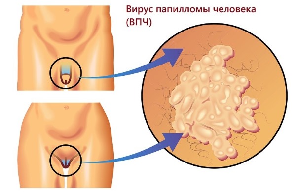 HPV in women - what is it, symptoms, types, how is it transmitted, treatment of human papillomavirus in gynecology