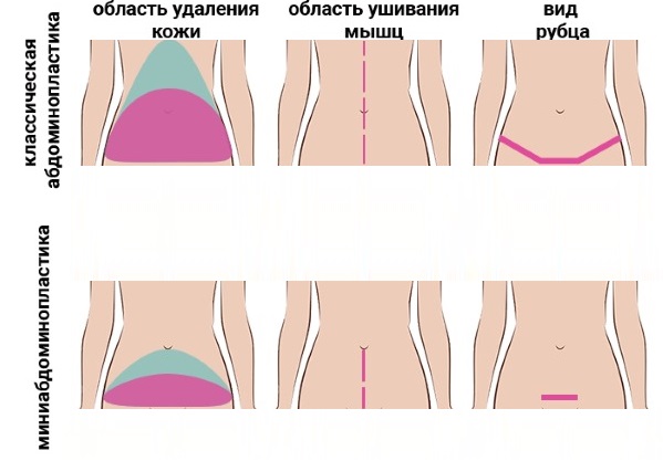 Addominoplastica dell'addome. Che tipo di operazione è, come si fa, foto prima e dopo, indicazioni e controindicazioni, conseguenze