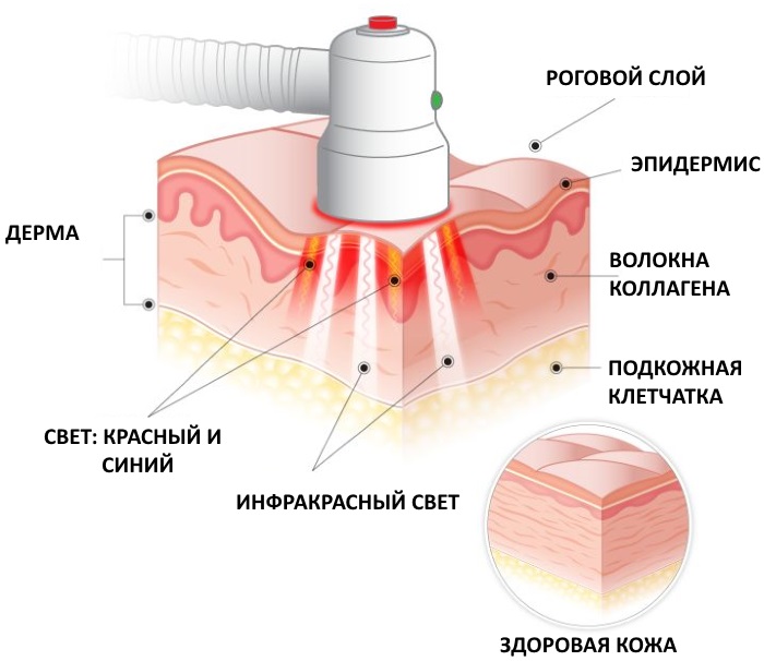 Photodynamische Therapie in der Kosmetik. Wie ist das Verfahren, Indikationen und Wirksamkeit