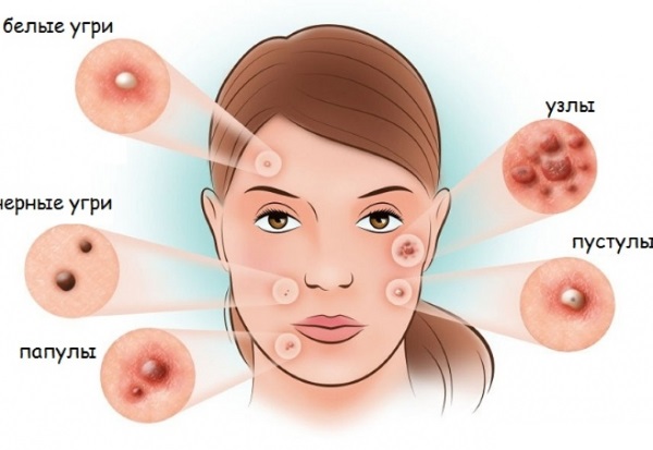 Photodynamische Therapie in der Kosmetik. Wie ist das Verfahren, Indikationen und Wirksamkeit