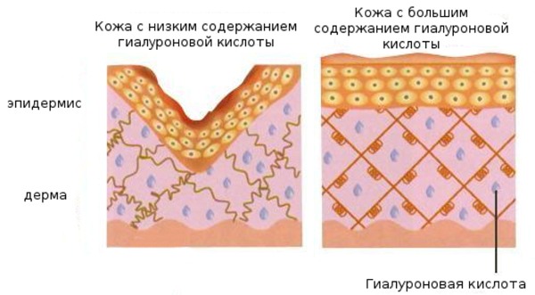 Hyaluronic acid for face in injection for injections. What drugs are better, how to apply, how it works, results, before and after photos, price in a pharmacy