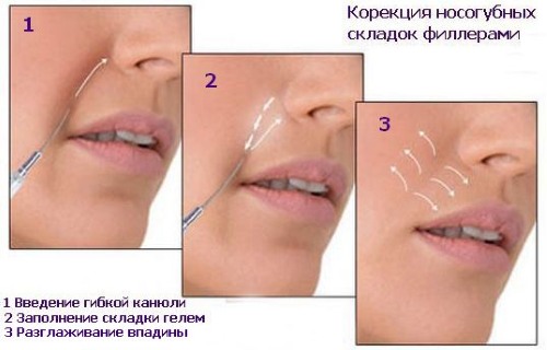 Hyaluronic acid for face in injection for injections. What drugs are better, how to apply, how it works, results, before and after photos, price in a pharmacy