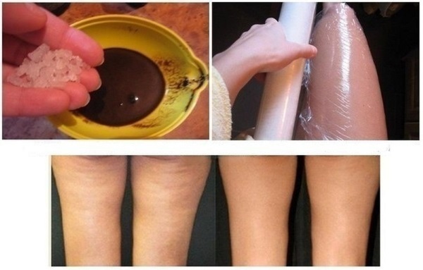 How to quickly get rid of stretch marks on the pope and hips, body, abdomen at home