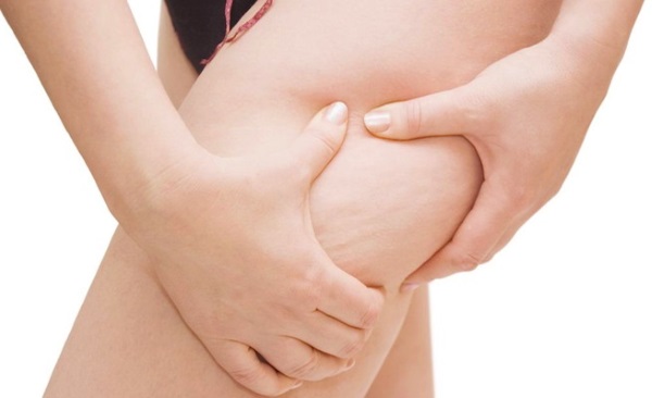 Come sbarazzarsi rapidamente delle smagliature su glutei e fianchi, corpo, addome a casa