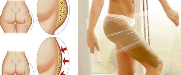 How to quickly get rid of cellulite on the butt and legs: wraps, massage, exercises