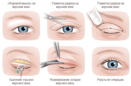 How to get rid of the impending century at home. Traditional methods, cosmetic procedures, surgery, creams and ointments