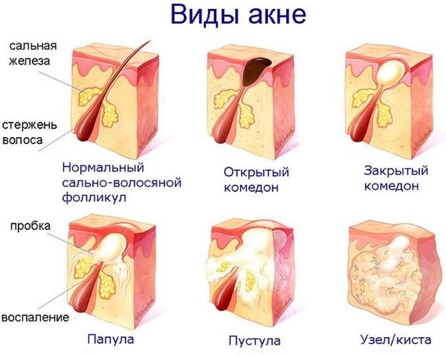 Lactofiltrum for acne: reviews of dermatologists with photos before and after. Instructions for use, analogues, price